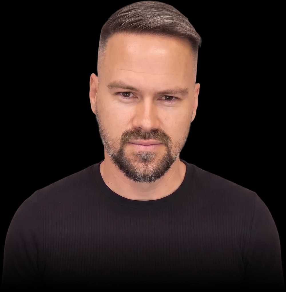 Klient NewLooks po transplantácii vlasov